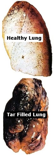 Incorrectly Labeled Example of Smoker's Lung